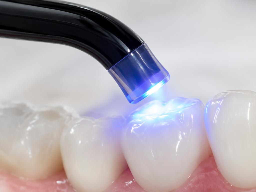 Resinas dentales en Fumero Dental Center, Escazú
